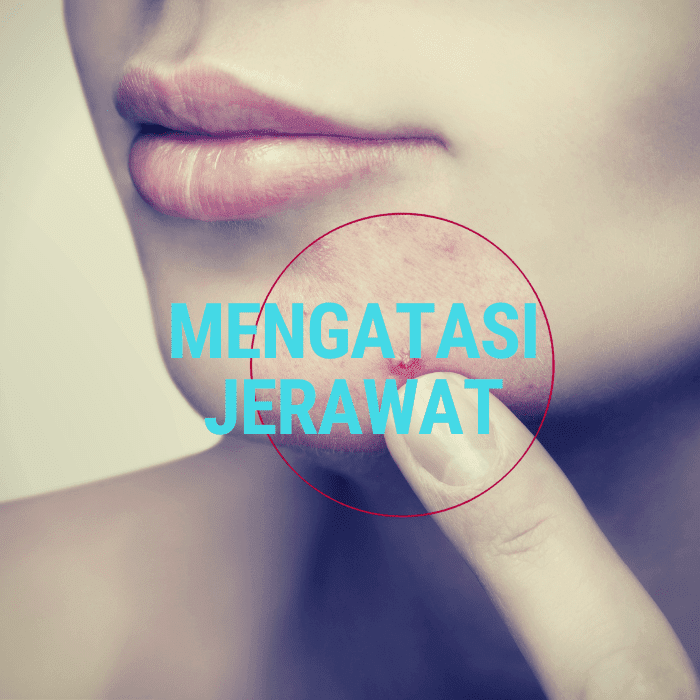 Lendir siput untuk jerawat