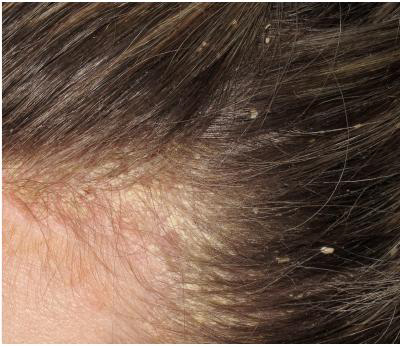 dolor cuero cabelludo vitiligueando psoriasis i dolor cuero cabelludo vitiligueando psoriasis i