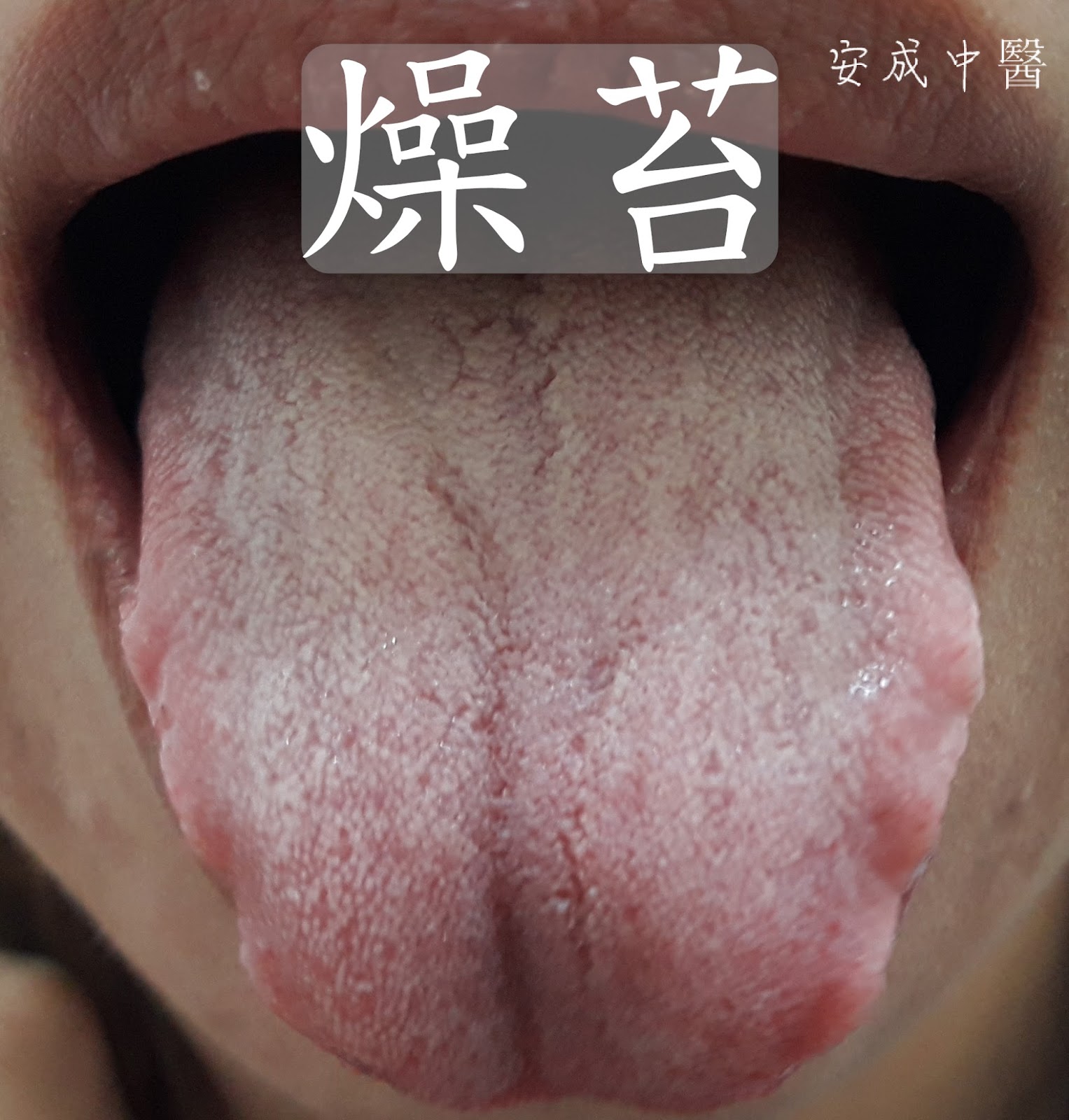 中医舌诊：舌苔发黄的9个秘密_黄色