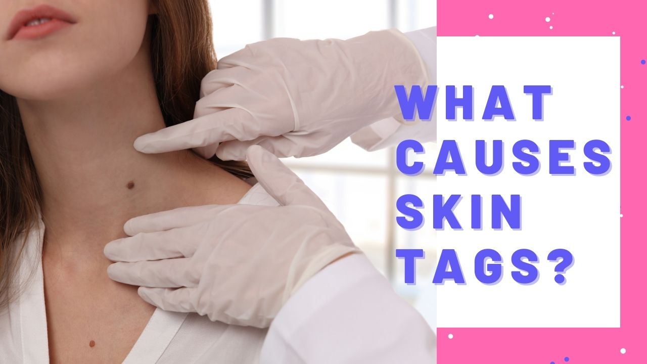 Skin-Tags-causes-symptoms-on-neck-treatment-2021
