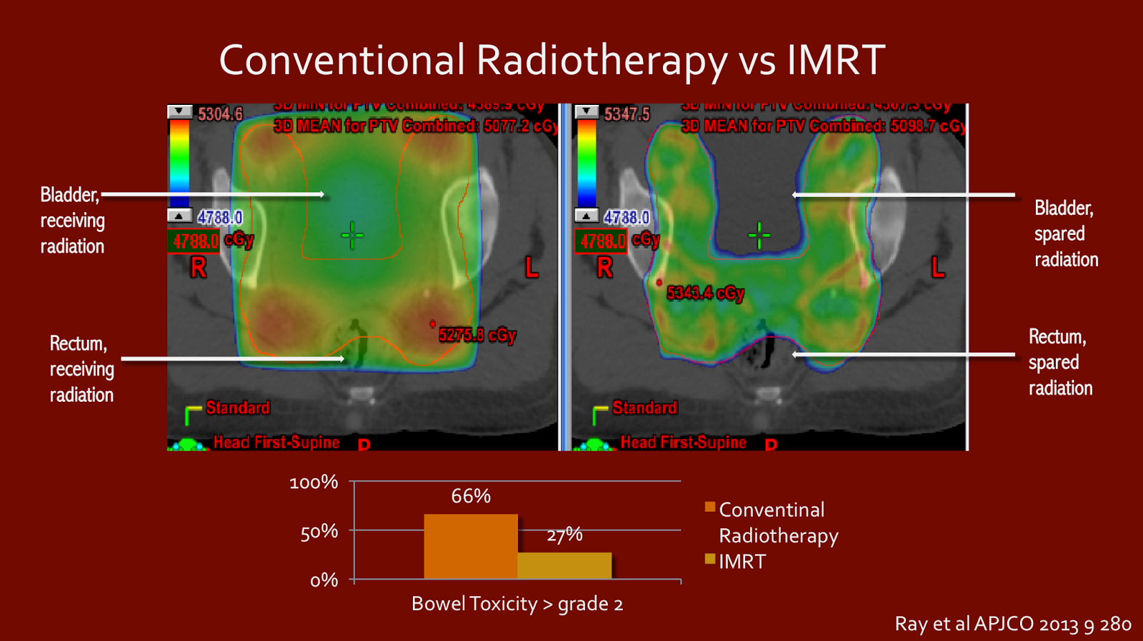 cancerradiotherapyinfo Modern radiation techniques for treating