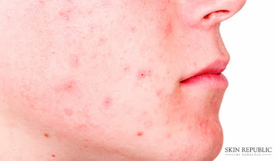 tác hại của vi khuẩn P.acnes
