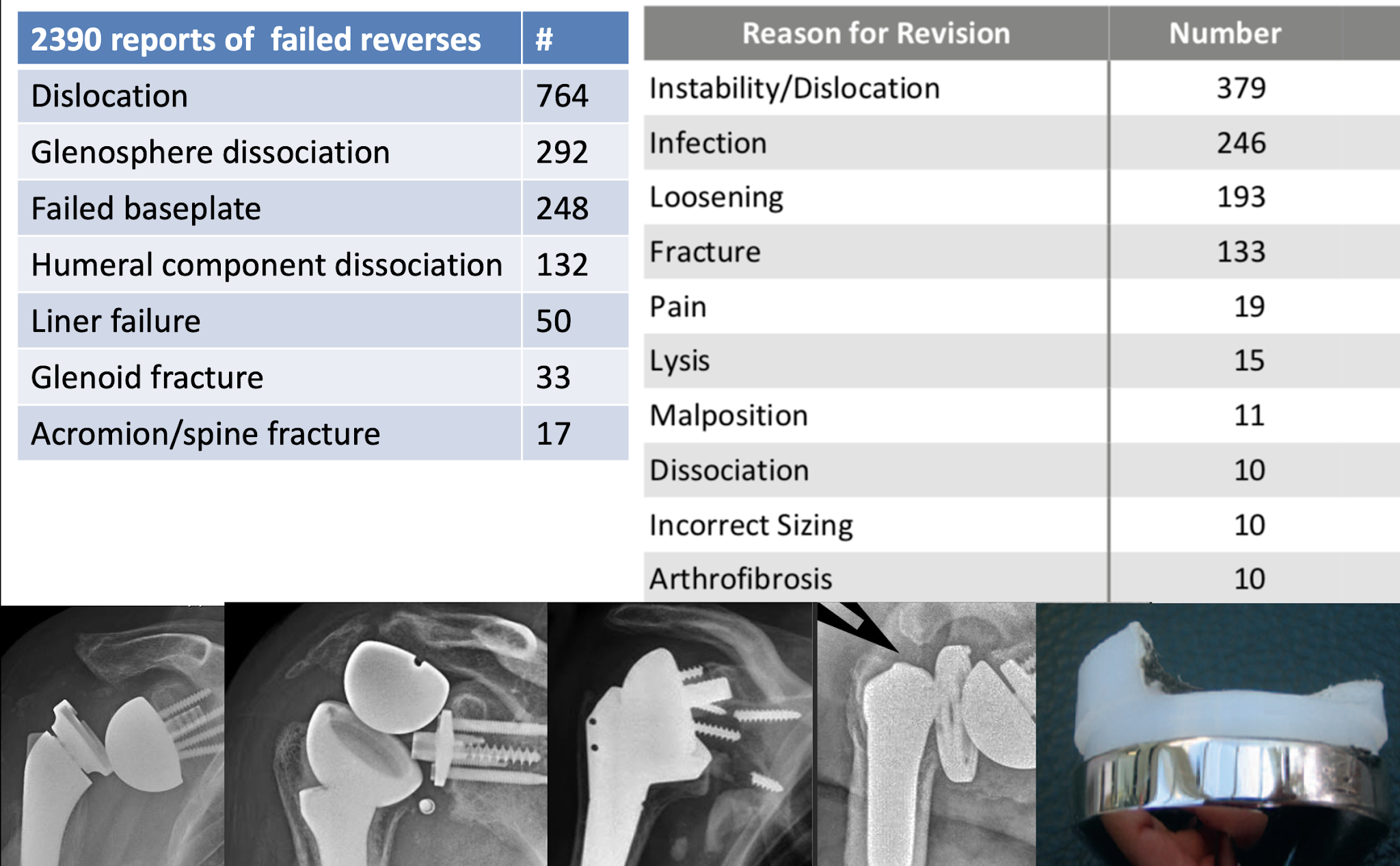 UW Shoulder and Elbow Academy Reverse total shoulders how many cases