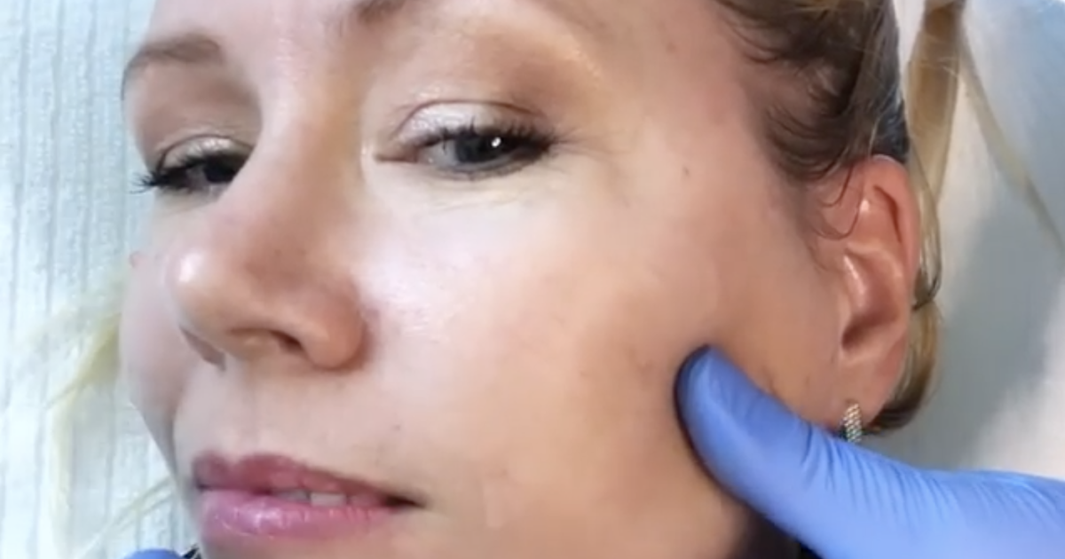 Microdermabrasion vs Dermaplaning which one is better?