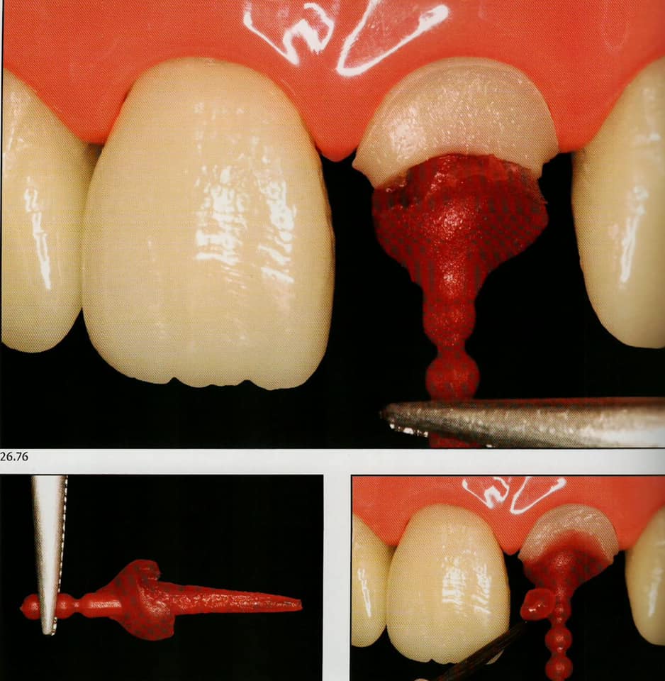 Cast metal posts Dental Esthetics