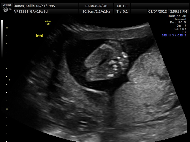 Keeping up with the Joneses 20 Week Ultrasound
