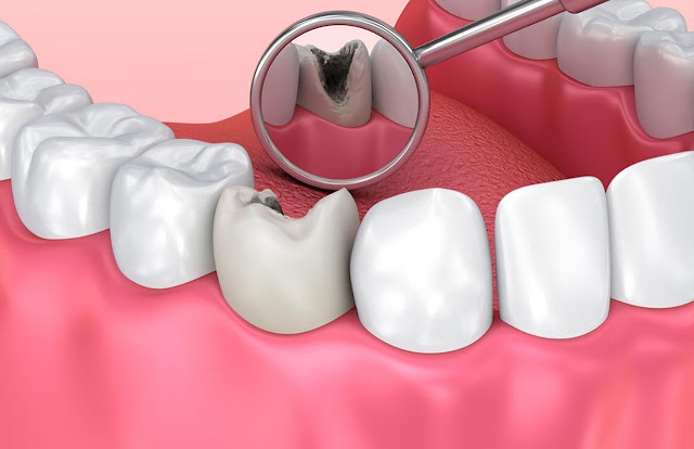 manifestations of tooth decay