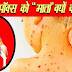 चिकेनपॉक्स (छोटी माता) क्या हैं? | Chickenpox or Chhoti Mata in Hindi