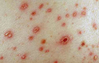 Sintomas de la varicela