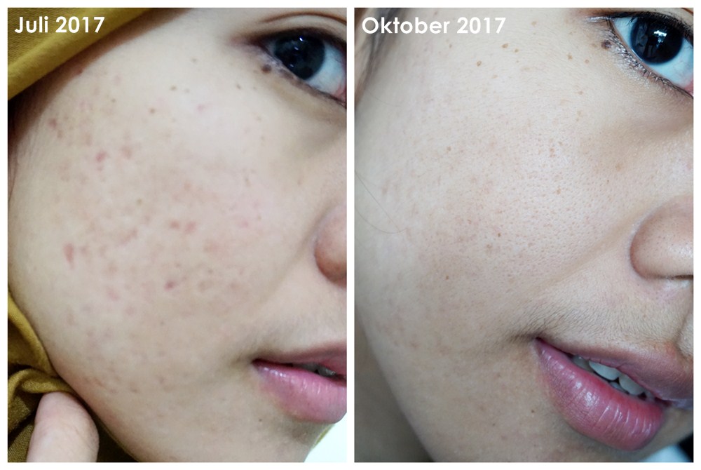 Klairs Freshly Juiced Vitamin Drop Before And After