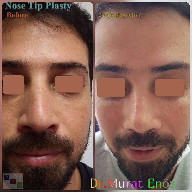 Male Nose Tip Plasty Surgery in Turkey,Nose Tip Reshaping For Men,Nose Tip Surgery For Men,Male Nose Tip Plasty Operation in Istanbul,Men's Nose Tip Plasty,