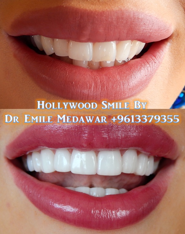 Dr Emile Medawar Veneers Hollywood Smile, 00 9613 379355 veneers dubai