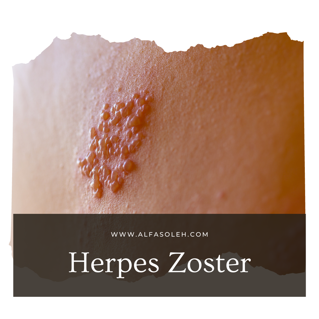 Mengenal Herpes Zoster Beserta Mitos dan Faktanya