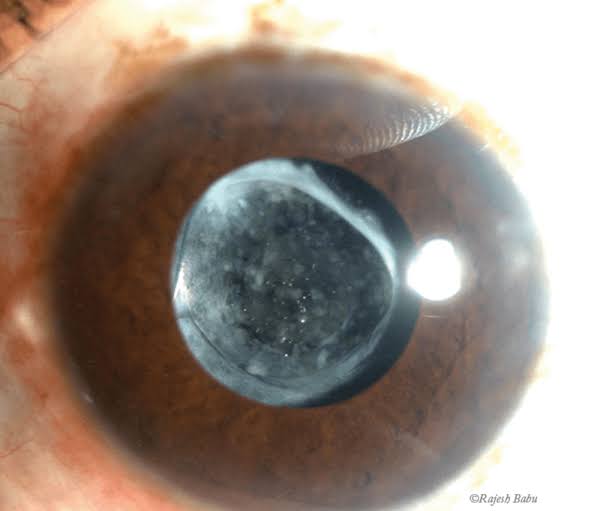 What is posterior capsular opacification