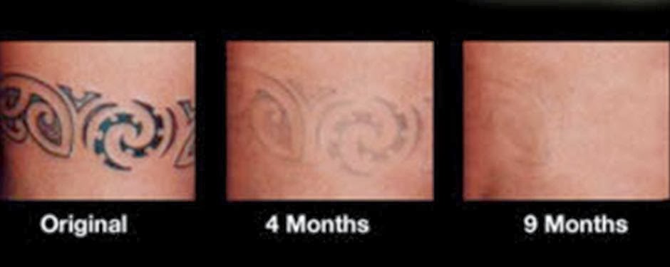 Before and After Photos of Tattoo Removal Cream