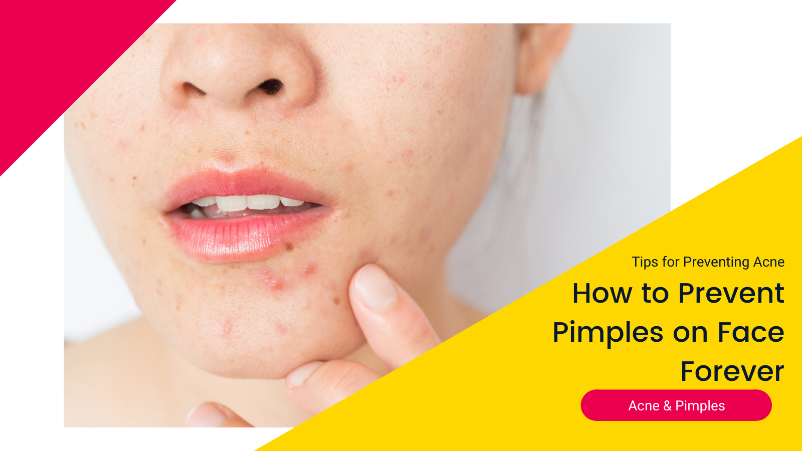 how-to-prevent-pimples-face-forever-2020
