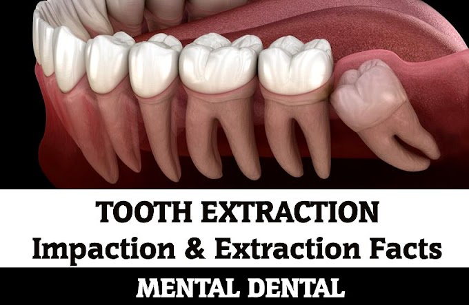 TOOTH EXTRACTION: Impaction & Extraction Facts - Mental Dental