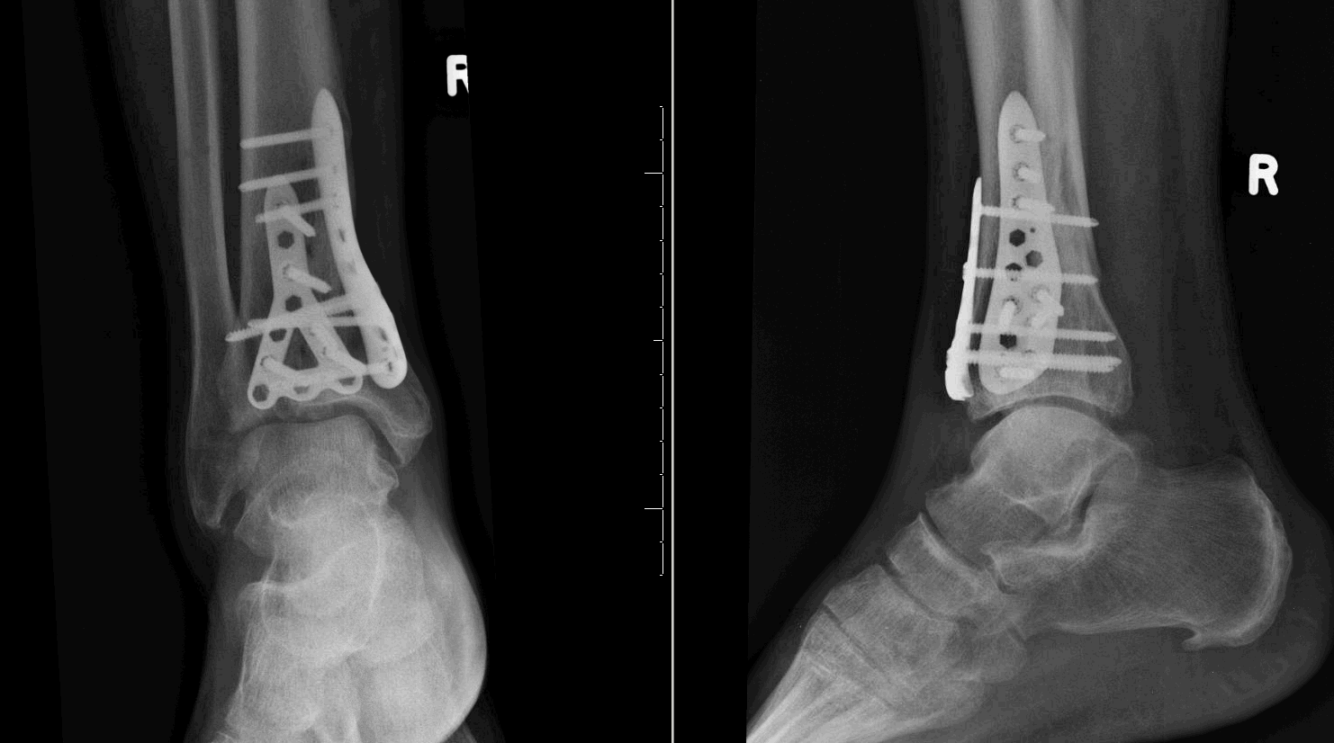 pilon fracture orif cpt pilon fracture orif cpt