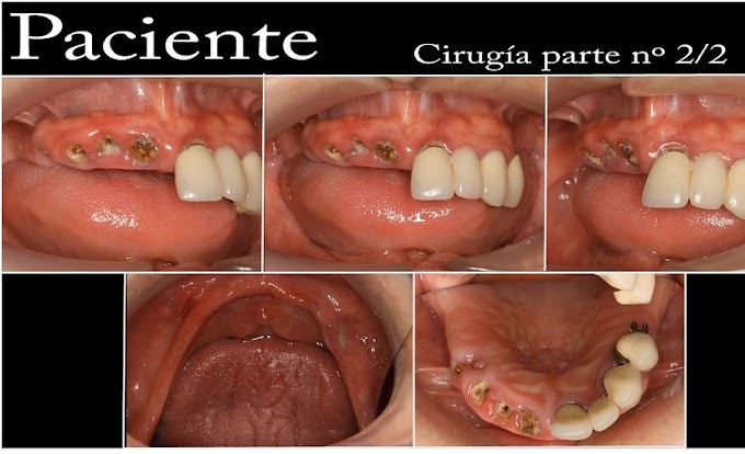 CARGA INMEDIATA: Implantes Post extracción - Video 2