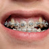 Răng khấp khểnh là tình trạng gì?