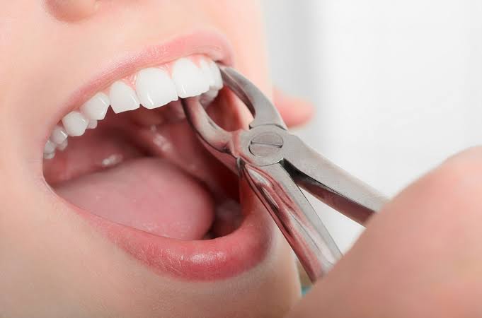 Sakit rasa mencabut gigi tanpa geraham cara sendiri 10 Cara