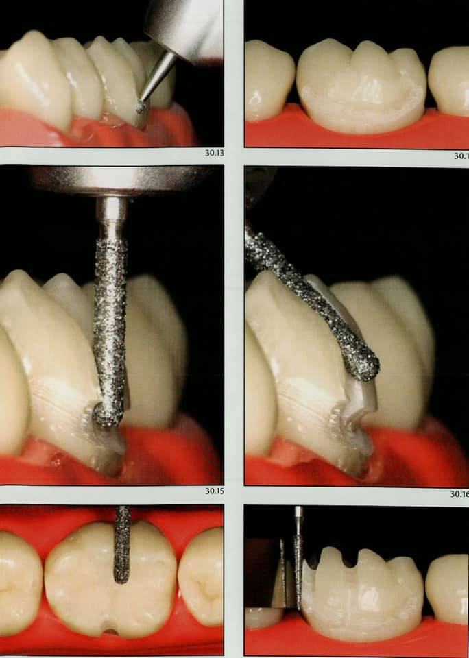 Posterior crown preparation Dental Esthetics