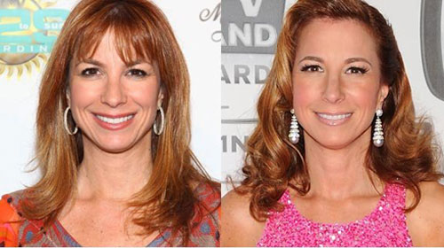 Jill Zarin Plastic Surgery Before and After Botox - Star Plastic