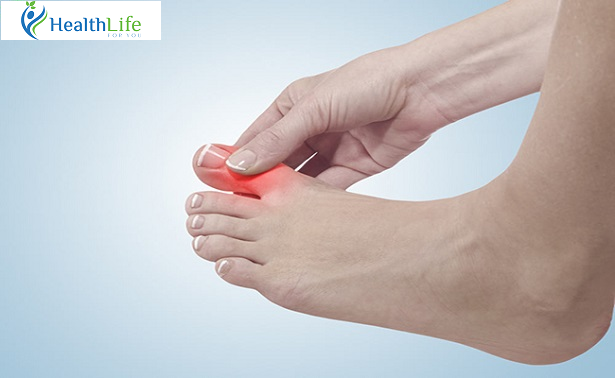 Symptoms Of Gout - The Signs Of The Disease Symptoms Of Gout - The Signs Of The Disease
