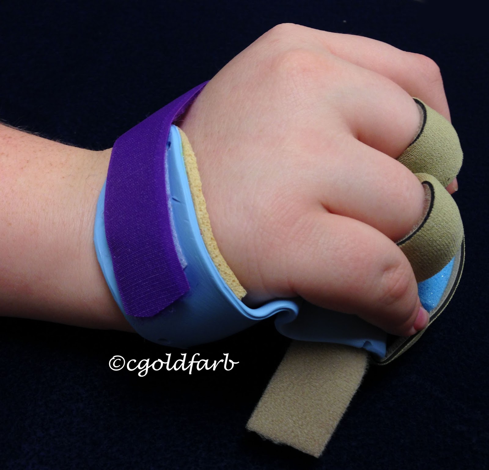 Camptodactyly bent finger treatment with splinting Congenital Hand