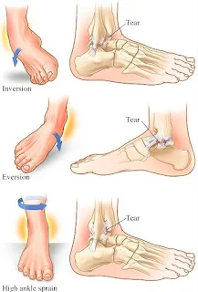 Classification of Ankle Sprains, Healing Process and treatments