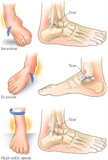 Classification of Ankle Sprains, Healing Process and treatments