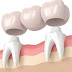 Làm cầu răng có ưu và nhược điểm gì?