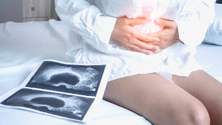 Penyebab Terjadinya Kista di Rahim Yang Kamu Harus Ketahui