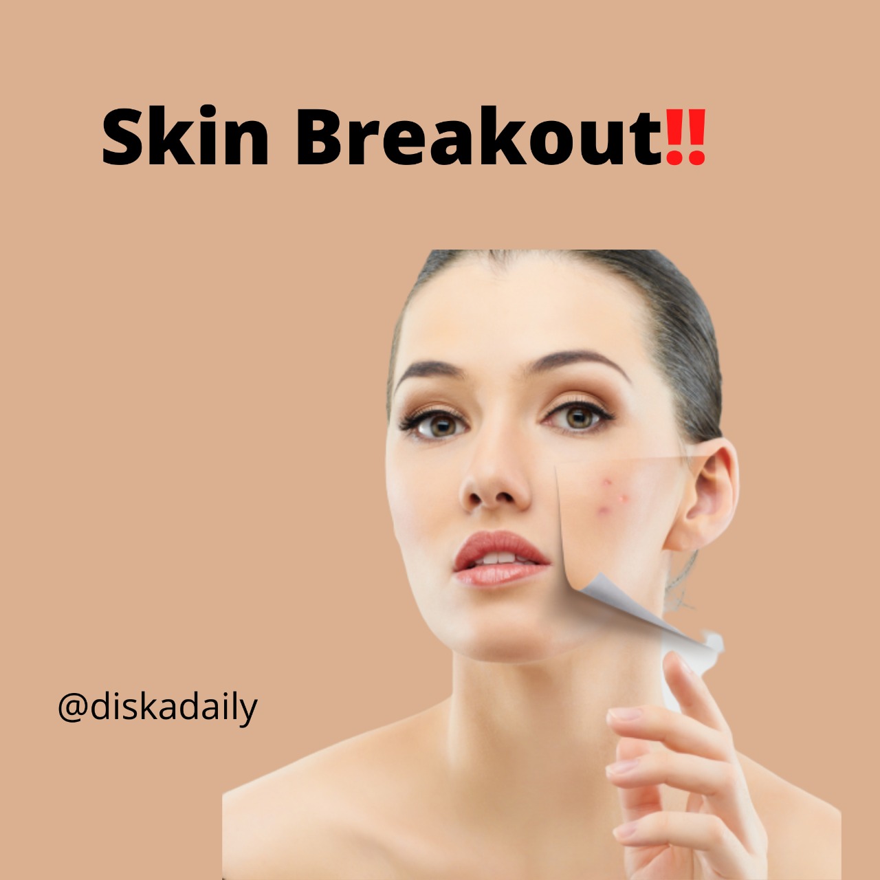 Diska Widya Astuti Perbedaan Skin Breakout dan Skin Purging