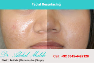 Facial Resurfacing In Lahore treatment by the best plastic surgeon in Lahore