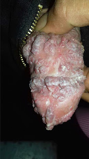 Obat Kutil Di Kelamin Obat Kutil Di Kelamin
