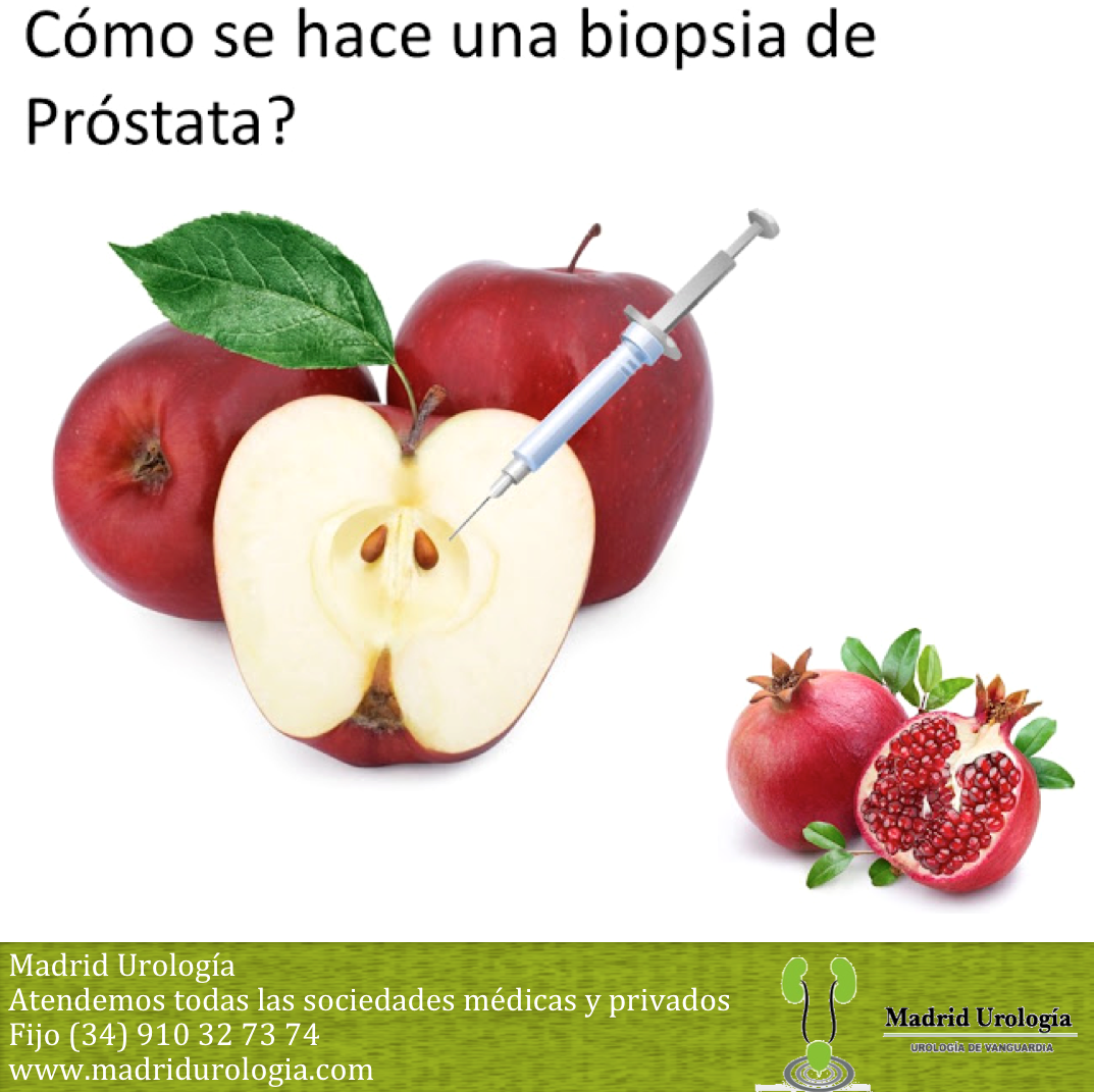 Cómo preparar una biopsia de próstata