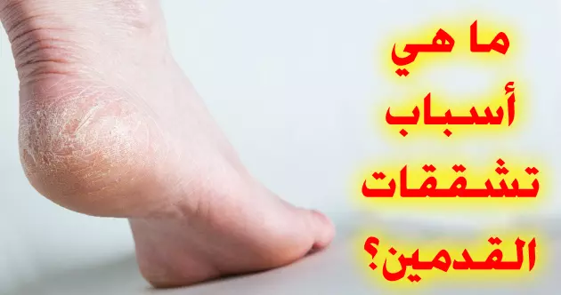 ماهي أسباب تشققات القدمين تشققات الأقدام