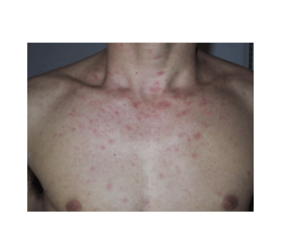 Maculopapular Rash - Pictures, Causes, Treatment, Diagnosis