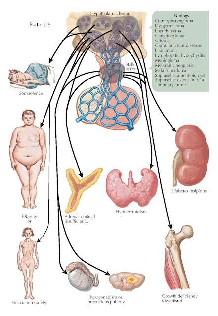 MANIFESTATIONS OF SUPRASELLAR DISEASE
