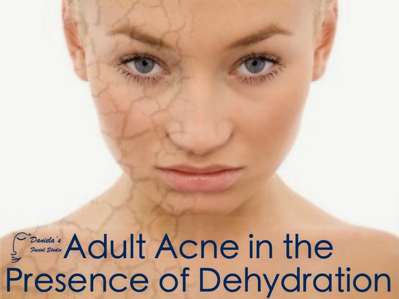 The Acne Whisperer Adult Acne In The Presence Of Dehydration Part 1