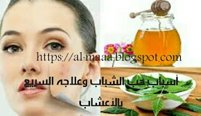 أسباب حب الشباب وعلاجه السريع بالأعشاب