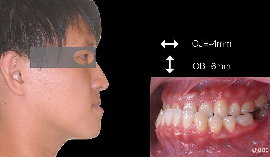 ORTHODONTICS Severe Skeletal Class III Correction with Class III