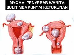 Waspadai Penyakit Mioma