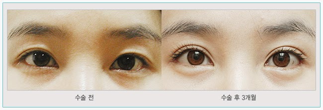 Двойное веко до и после иллюстрация штока. иллюстрации насчитывающей мышца - 166