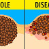 Dangerous Myths About Moles and Suntan You Need to Stop Believing