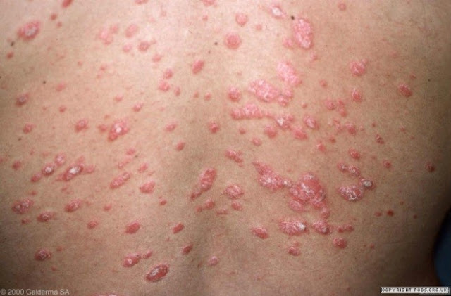 Tak Perlu Cemas Jika Terkena Penyakit Kulit Psoriasis..Lakukan Hal Ini ...