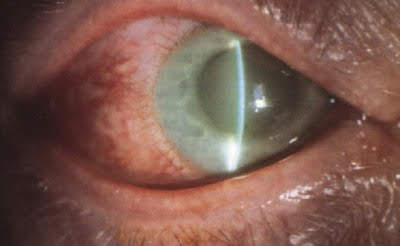 Glaucoma  γλαύκωμα