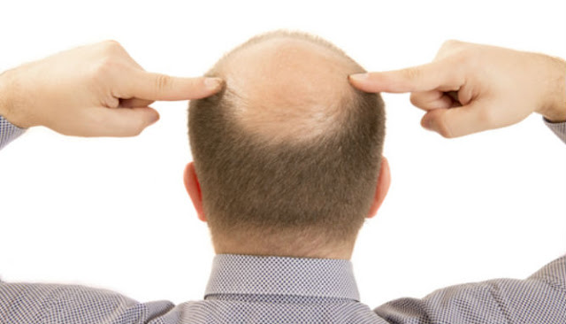 Penyebab Kepala Botak di Tengah dan Cara Mengatasinya