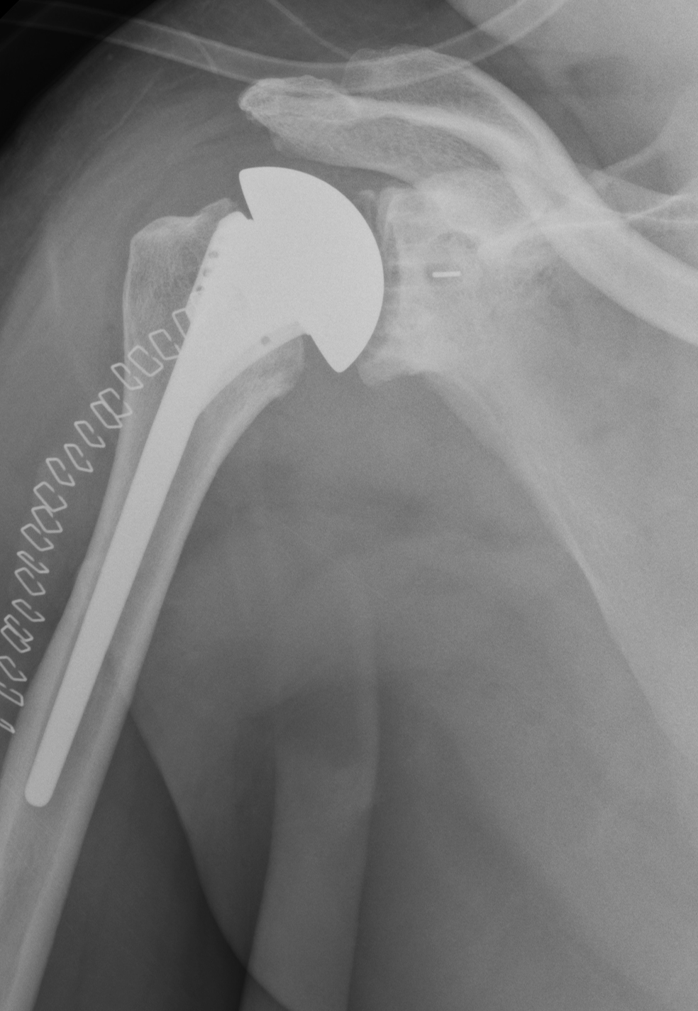 Shoulder Arthritis / Rotator Cuff Tears / Shoulder Pain Total